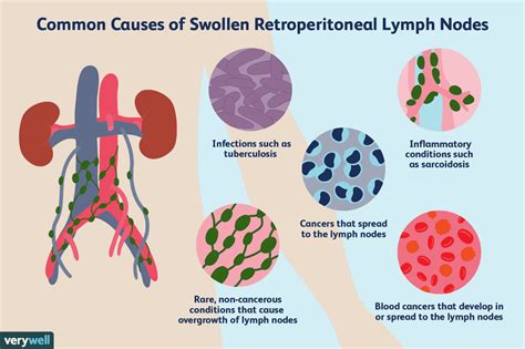 Retroperitoneal Lymph Nodes Cancer Symptoms