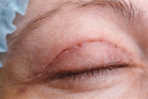 Eyelid Surgery Preparation Recovery Long Term Care