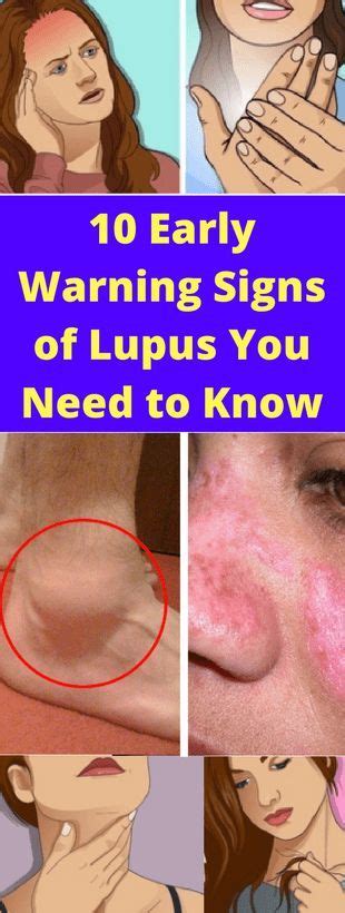 Here Are Early Warning Signs Of Lupus You Need To Know Healthy
