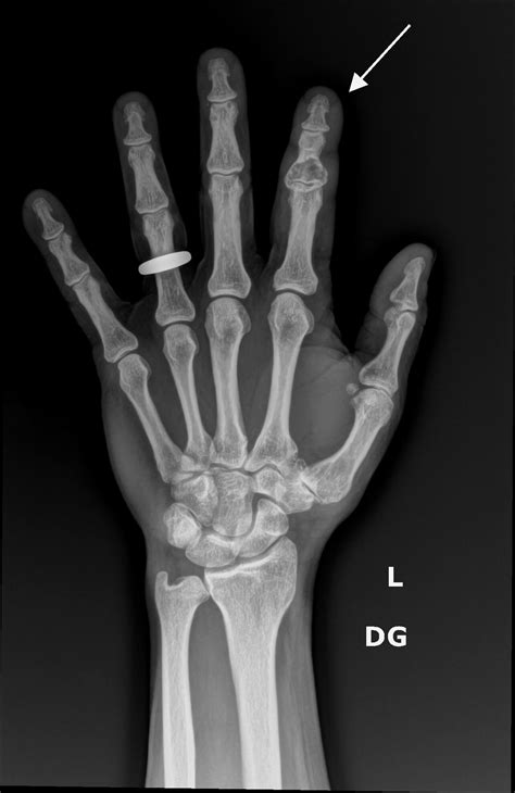 Orthodx Fracture Through A Cyst On Index Finger Clinical Advisor