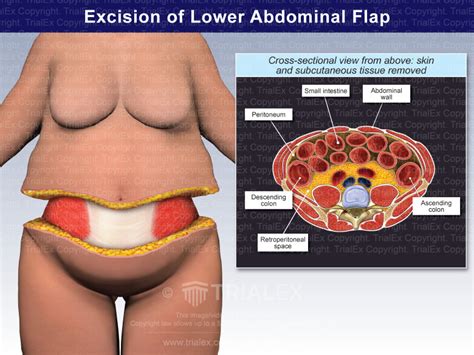 excision of lower abdominal flap trial exhibits inc