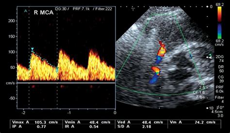 Use Of Transcranial Doppler Ultrasonography In The Pediatric Intensive
