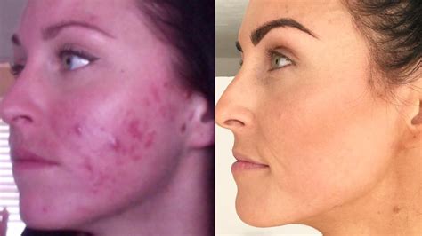 Dermatologist Before And After Acne