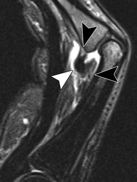 Avulsion Injuries Of The Hand And Wrist Radiographics