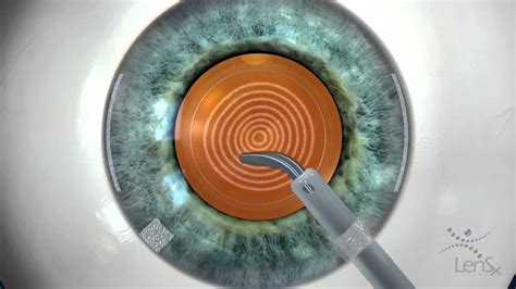 Stephen Slade Md Laser Cataract Surgery Animation Youtube