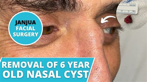 Removal Of 6 Year Old Nasal Cyst Dr Tanveer Janjua New Jersey