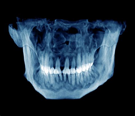 # difference between periapical granuloma and periapical cemental dysplasia: Cemental Dysplasia Photograph by Zephyr/science Photo Library
