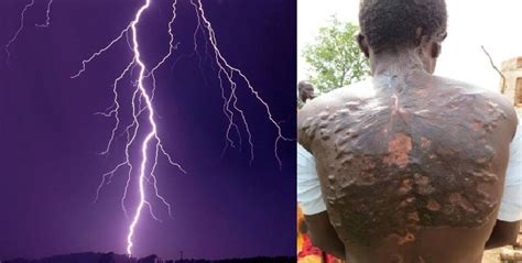 Lightning scars on skin are a unique phenomenon after all. People hit by lightning reveal their scars which look like fern leaves (Photos) - YabaLeftOnline