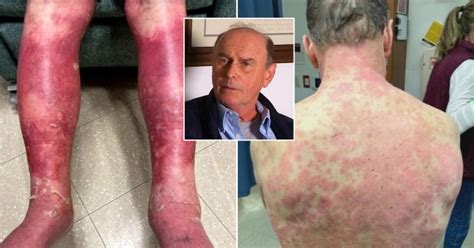 Covid Vaccine Us Man Suffered Rare Skin Reaction Metro News