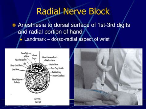 17 4ulnar Nerve Block Cpt Code Peripheral Nerve Blocks For Hand