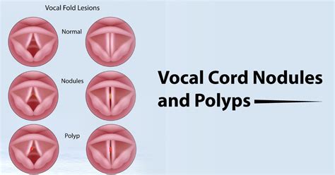 Vocal Cord Cysts And Polyps ~ Vikram Ent Hospital And Research Institute