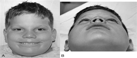 Undiagnosed Normocephalic Pancraniosynostosis Presenting As