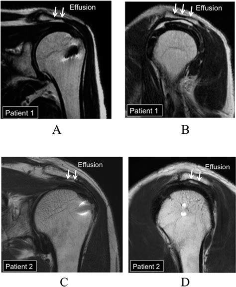 Mri Shoulder Rotator Cuff Anatomy