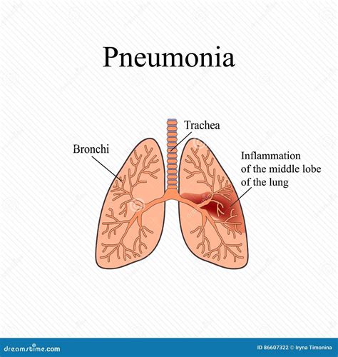 Pneumonia The Anatomical Structure Of The Human Lung Inflammation Of