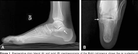 Figure 1 From Tarsal Tunnel Syndrome Associated With Os Sustentaculi A