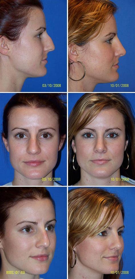 Rhinoplasty Nose Surgery Before And After Photos Miami Plastic Surgery