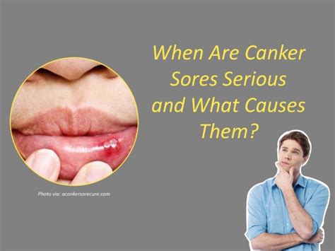 When Are Canker Sores Serious And What Causes Them