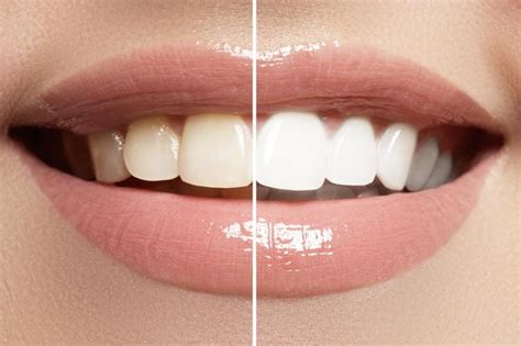 The Main Causes Of Tooth Discoloration And How To Fix It