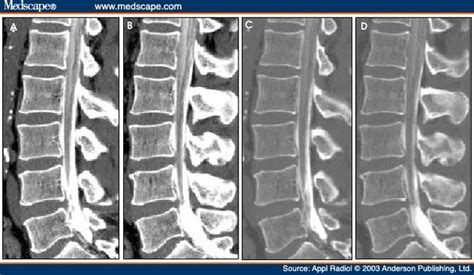 Lumbar Spine Ct Myelogram Lumbar Spine