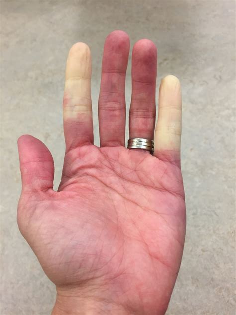 Raynauds Disease Diagnosis And Treatments Dont Get Left Out In The Cold Shandley Mcmurray