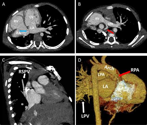 Frontiers A Case Of Rare Pulmonary Sequestration Complicated With