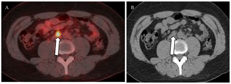 Cancers Free Full Text Oncologic Imaging Of The Lymphatic System