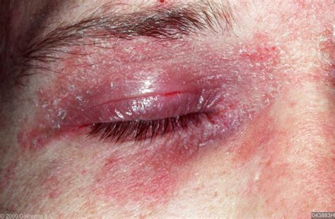 Dermatitis On Eyelids Pictures Photos