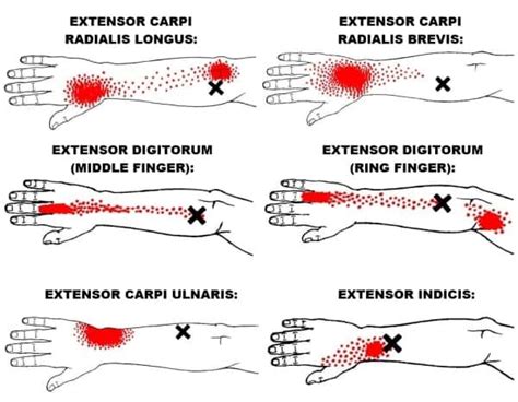 The Definitive Guide To Wrist Extensors Anatomy Exercises Rehab Trigger Points Massage