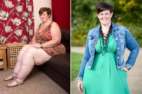 Woman With Tree Trunk Legs Weighing 4 Stone Each Desperate For