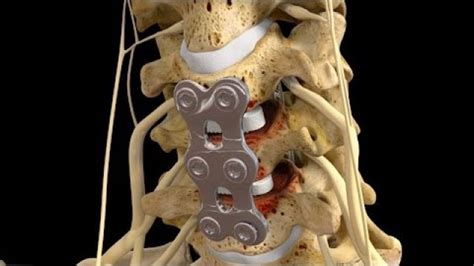 C5 6c6 7 Anterior Cervical Discectomy With Fusion Spinal Fusion