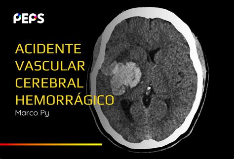 Acidente Vascular Cerebral Hemorrágico PEPS