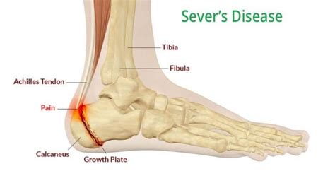 Severs Disease And Osgood Schlatter Disease Back In Action