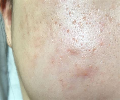 Acne What To Do About These Huge Under The Skin Bumps Cyst Nodule