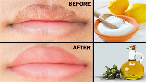 What Home Remedy For Dry Lips Lipstutorial Org