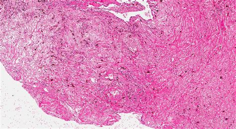Pathology Outlines Inflammatory Sinonasal Polyp