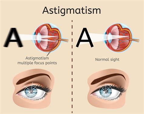What Are The Astigmatism Treatments In India