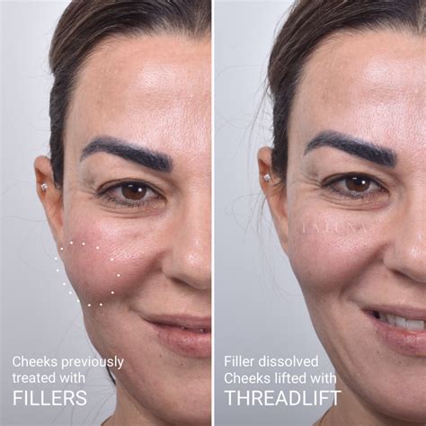 Thread Lift Sydney 1 Cosmetic Doctors Face Neck And Cheek Lift