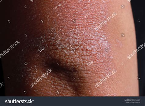 Close Dry Flaky Skin On Elbow Stock Photo 1066262225 Shutterstock