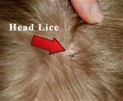 Head Lice | Facts | Pinterest