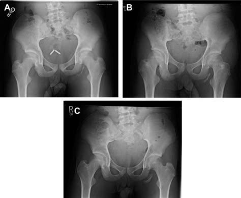 Pelvic Avulsion Injuries In The Adolescent Athlete Clinics In Sports