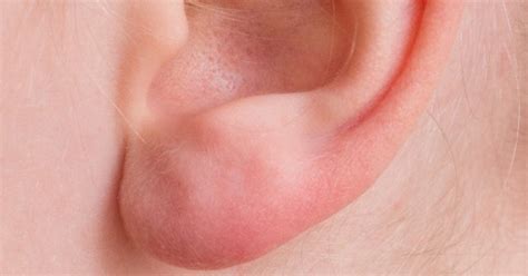 Medizin Pazifik Griff Neurodermitis Hinterm Ohr Abrunden Existieren Hölle