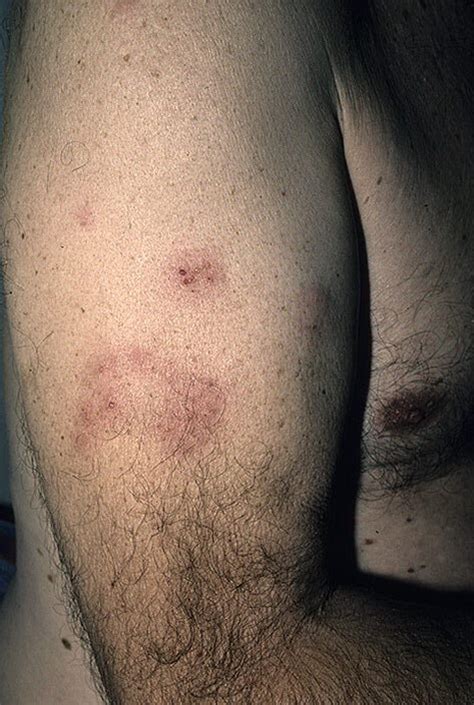 Your hammer missed the nail but hit your finger hard. Herpes on Hands Pictures - 48 Photos & Images / illnessee.com