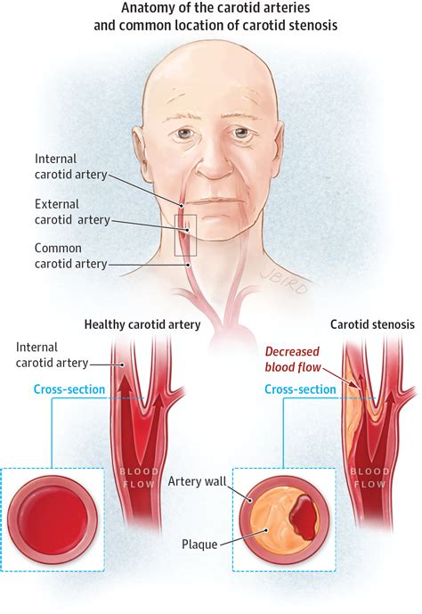 A blockage in one of the carotid arteries can be cleared either by endarterectomy or carotid angioplasty. Testing for Carotid Stenosis | Cerebrovascular Disease ...