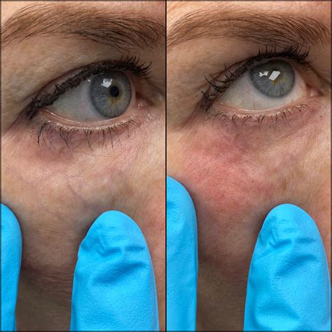 Laser Treatments Before And After Photos Flora Levin Md