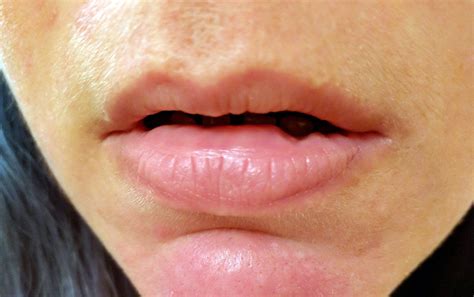 Why And How To Stop Biting Inside Of Lips Signs And Effects American Celiac