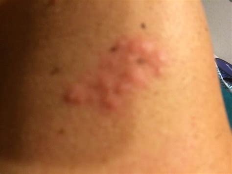 Bed Bug Bites On Arm Picture Of Miami International Airport Hotel