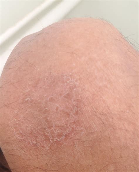 Ringworm Or Eczema This Is Behind My Elbow And Itches Moderately R