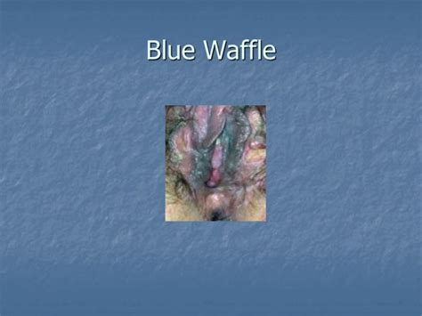 Most Circulated Pictures Of Blue Waffle Disease Shared Online Public Health