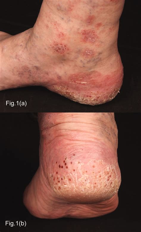 Atypical Psoriasis Following Rituximab For Rheumatoid Arthritis The