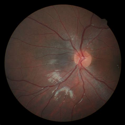 Choroidal Melanoma Eye Life Vision Center